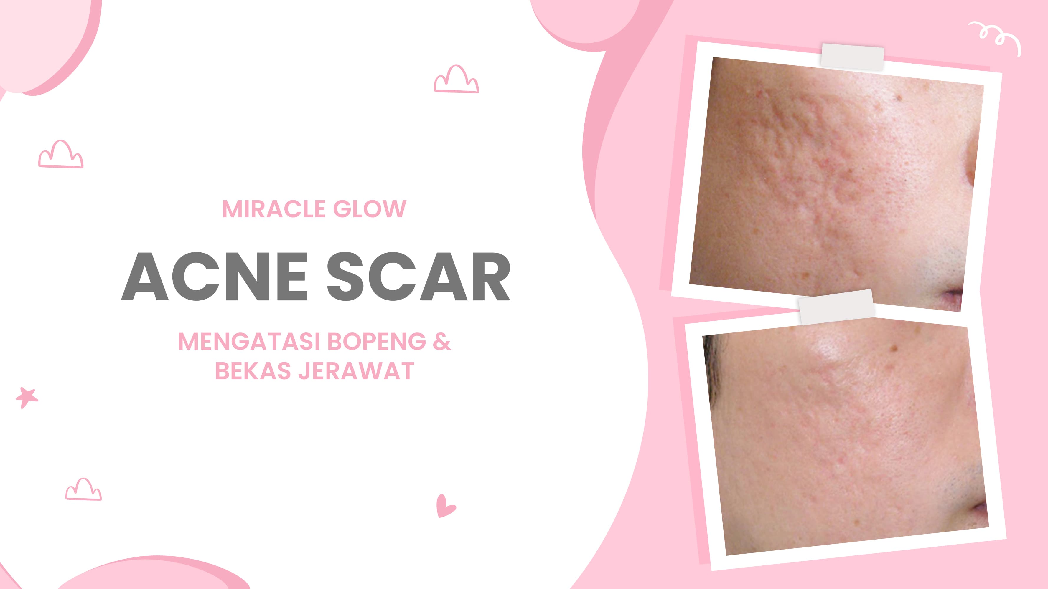 Lulu.id - Acne Scar 
