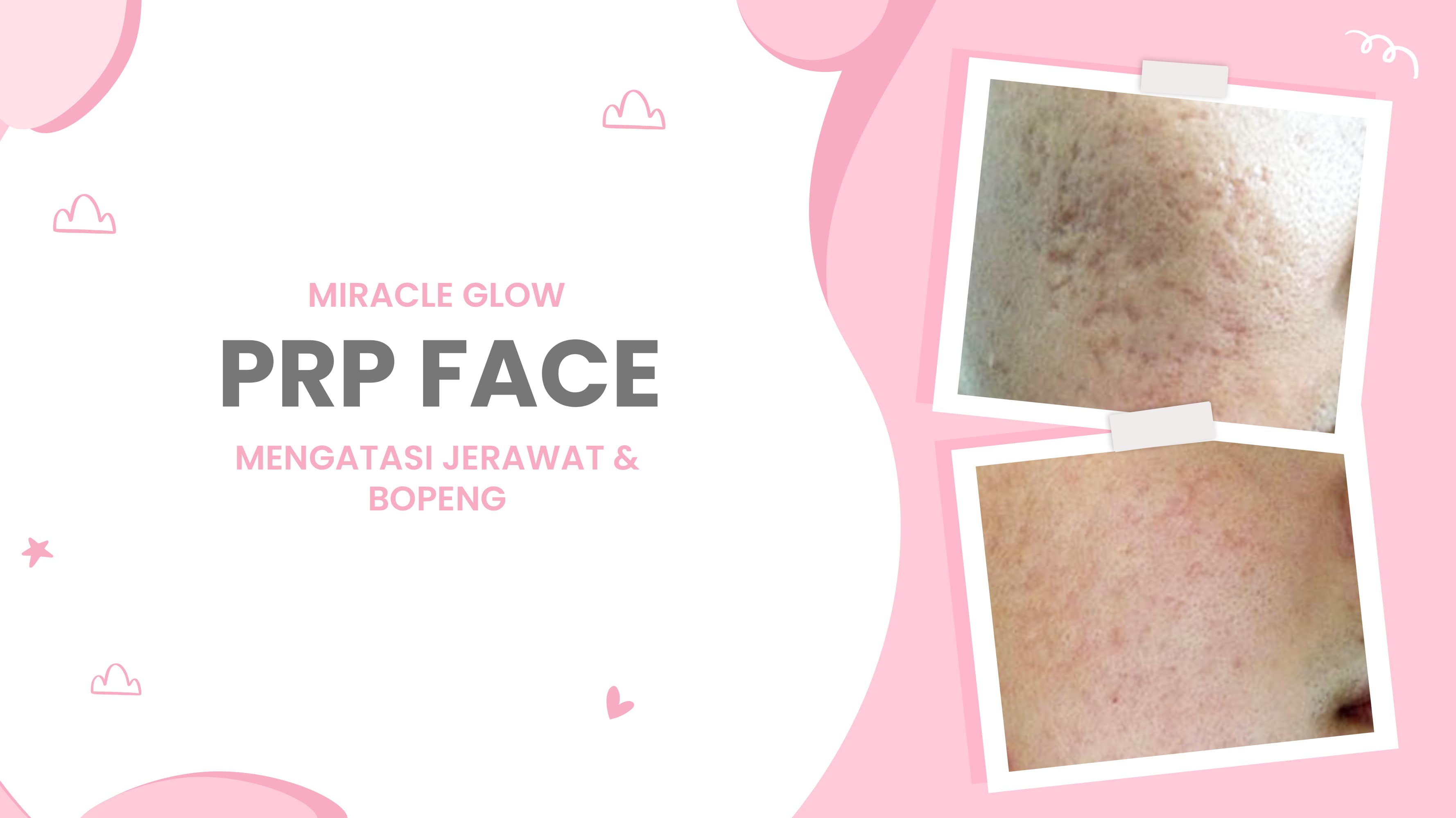 Lulu.id - PRP Face