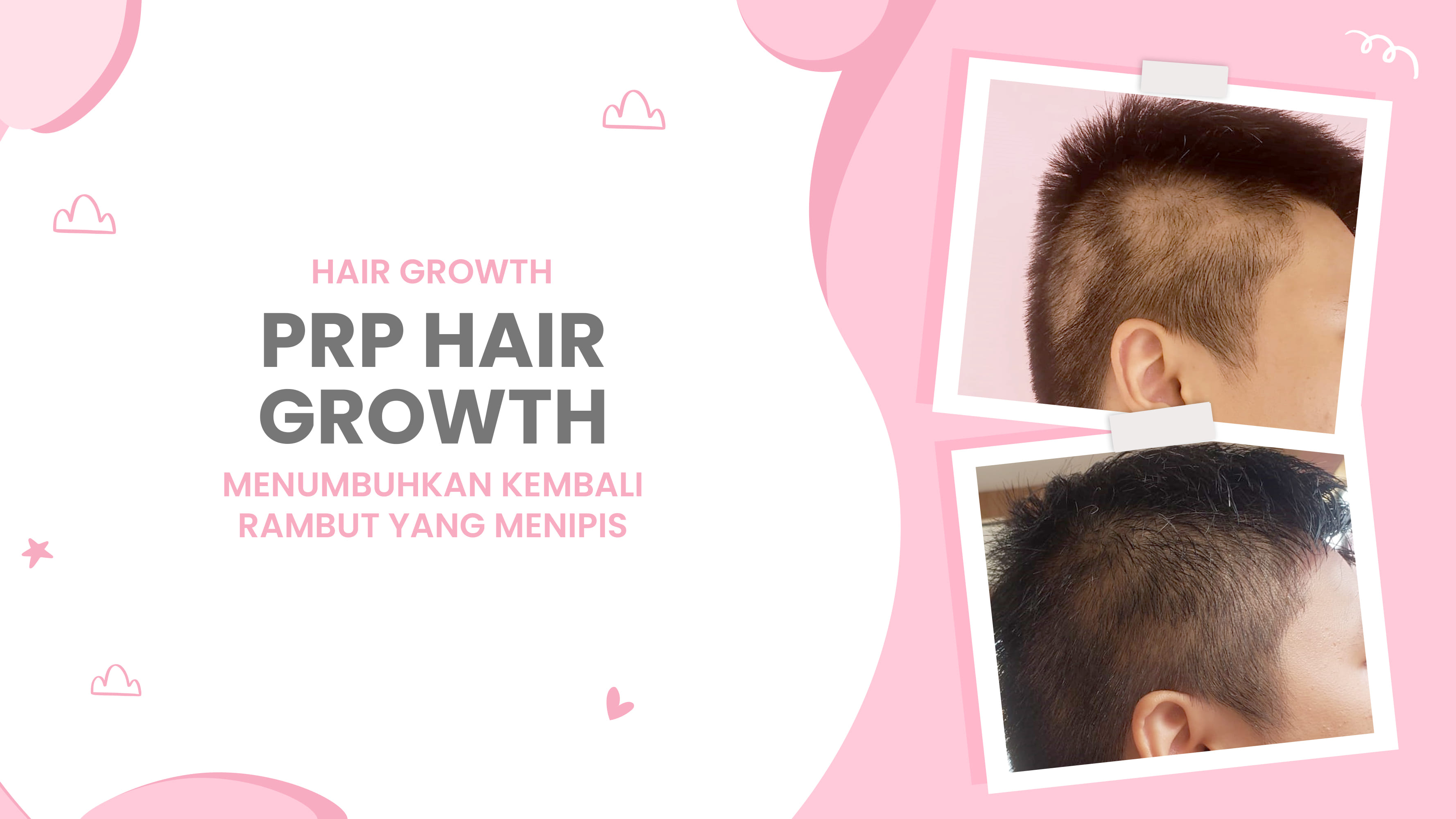 Lulu.id - PRP Hair Growth