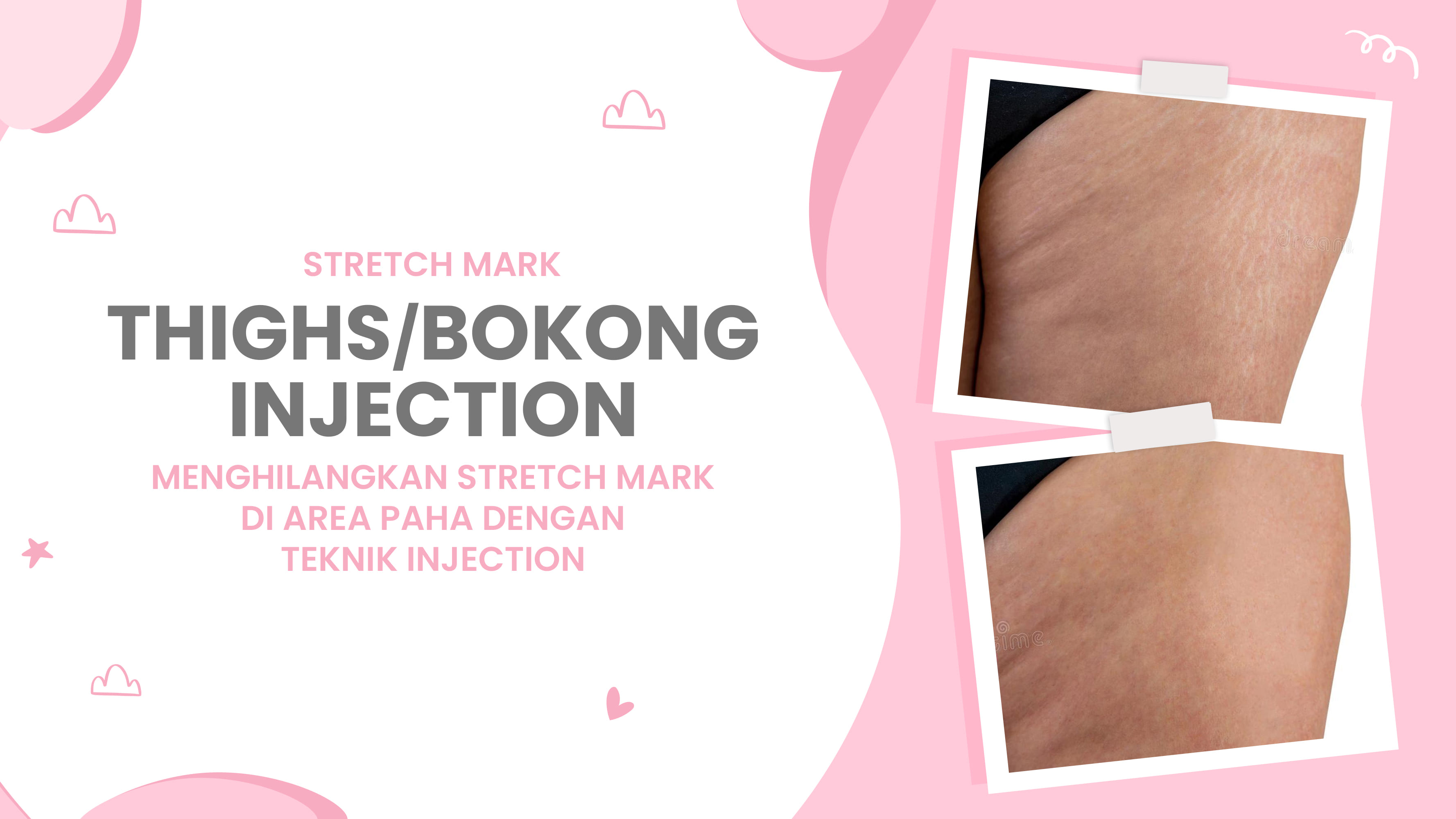 Lulu.id - Thighs/ Bokong Injection 